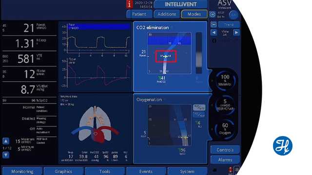 INTELLiVENT-ASV_Shift-PetCO2-target-range_youtube