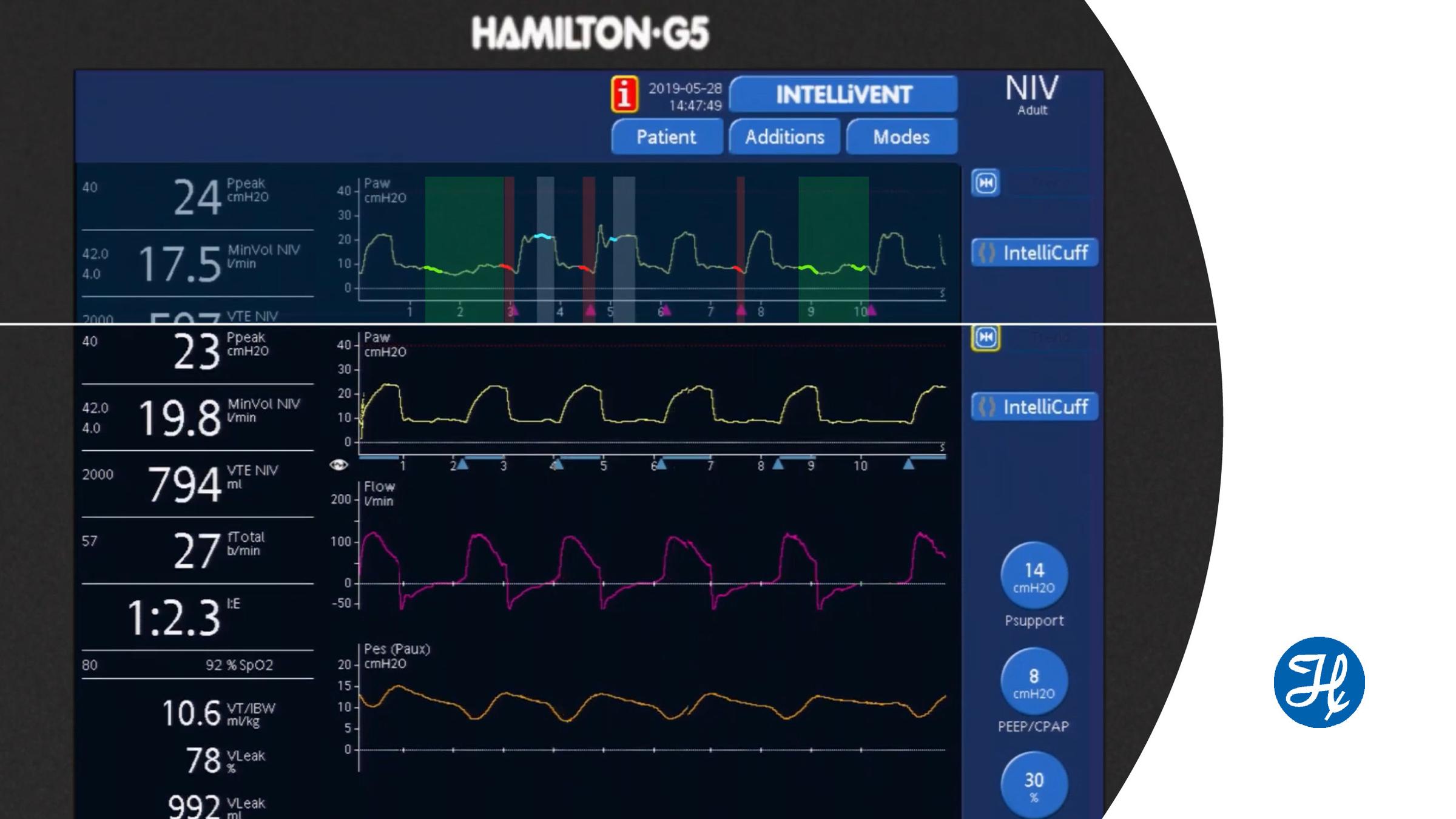 The new IntelliSync+ technology mimics the expert‘s eye by continuously analyzing waveform shapes at least hundred times per second. This allows IntelliSync+ to detect patient efforts immediately, and to initiate inspiration and expiration in real-time. In this video, we demonstrate you the effects of IntelliSync+ on patient-ventilator synchronization on a a real COPD patient in nonvasive ventilation. 00:00 Introduction 00:15 Different types of asynchronies with standard trigger settings 01:48 Synchronization with IntelliSync+ 02:28 Before and after comparison