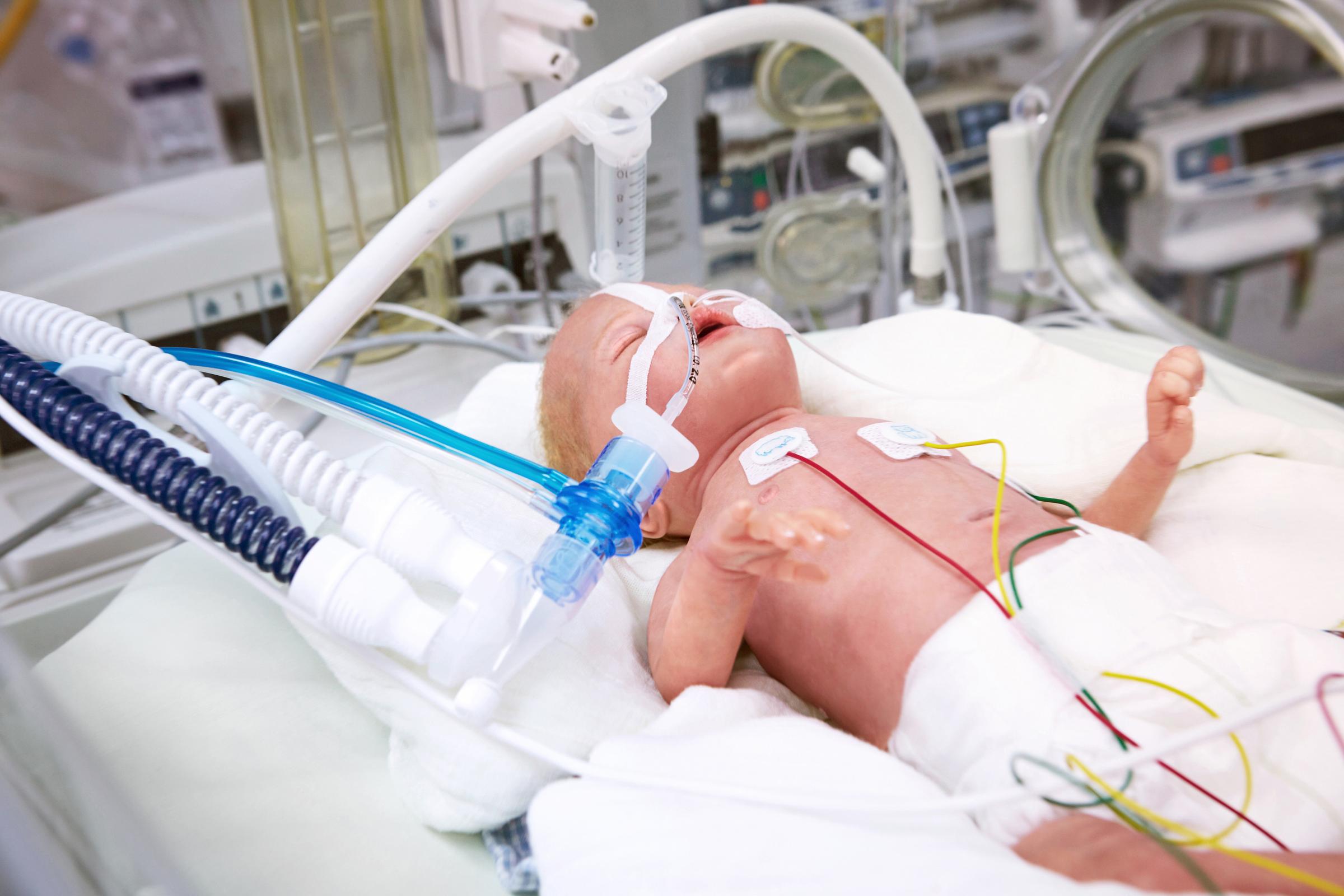 Neonatal patient on a ventilator intubated and with a flow sensor