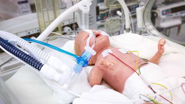 Neonatal patient on a ventilator intubated and with a flow sensor