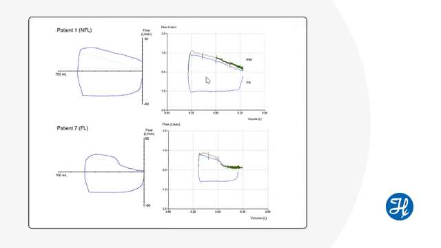 Journal Club: Manual compression of abdomen to assess expiratory flow limitation