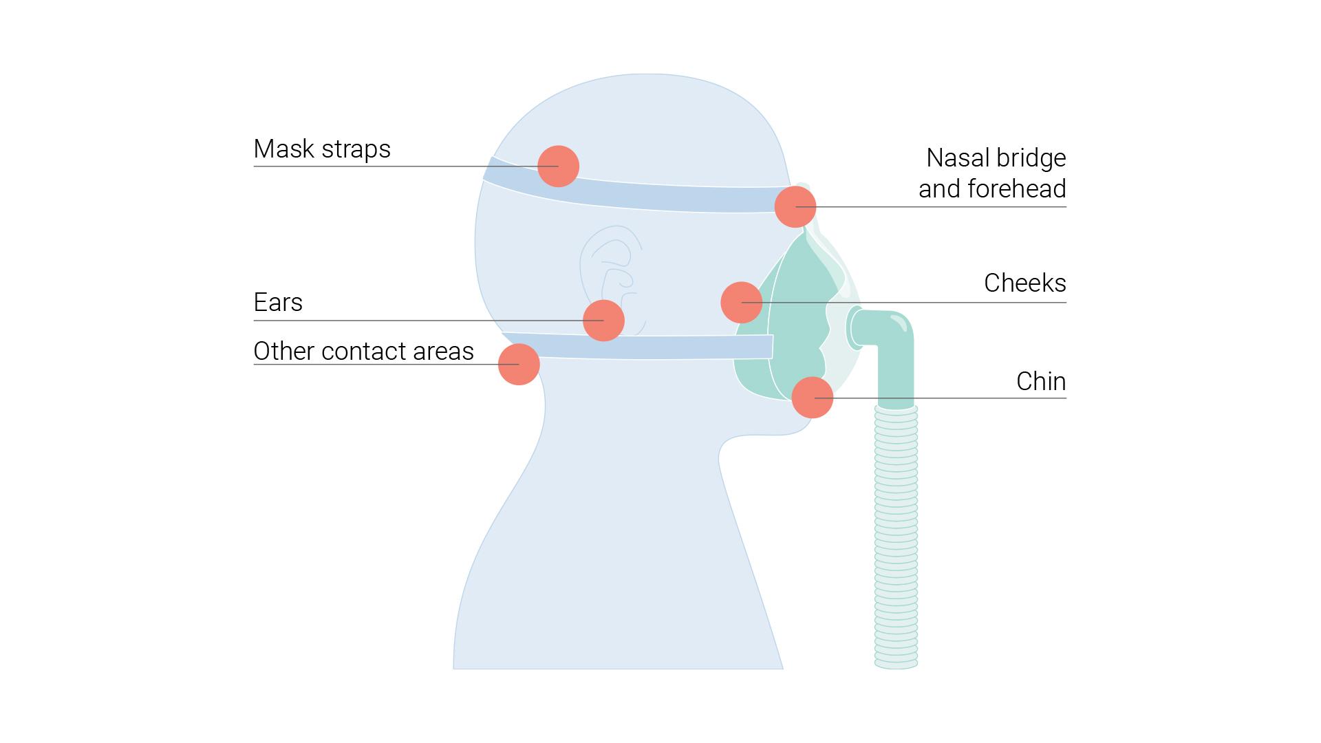 Illustration of head with red dots indicating pressure points 