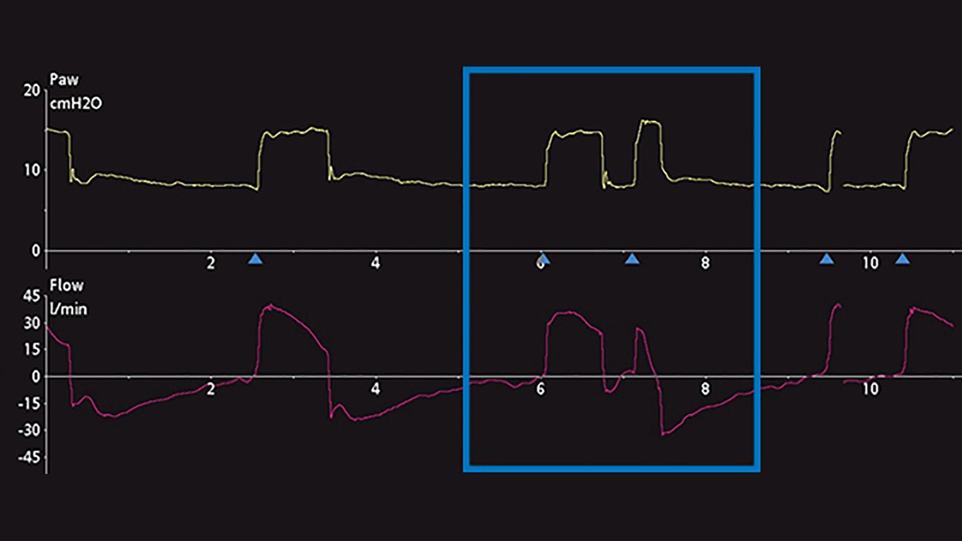 Double triggering Diagnosis, differentiation, and resolution