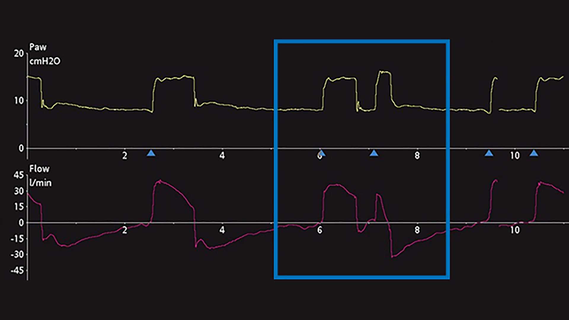 Pressure and flow waveforms showing double triggering