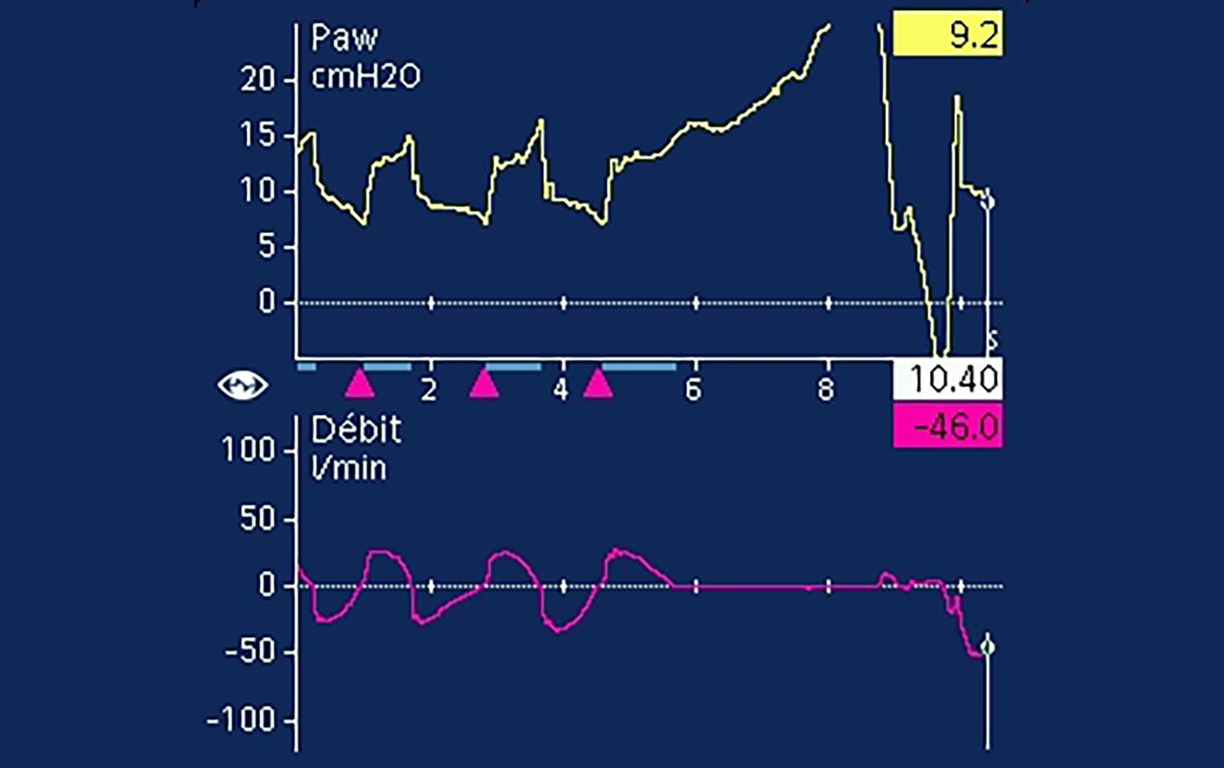 Screenshot showing non-readable plateau pressure due to expiratory muscle activity 