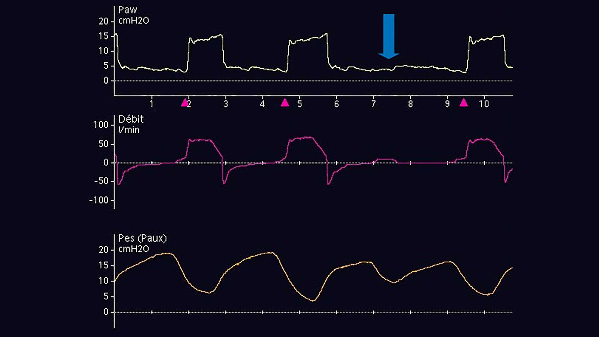 Esophageal pressure waveform showing decrease in pleural pressure at same point