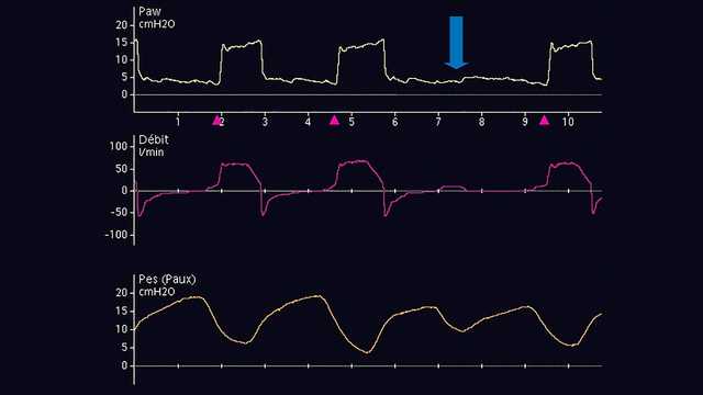 Esophageal pressure waveform showing decrease in pleural pressure at same point