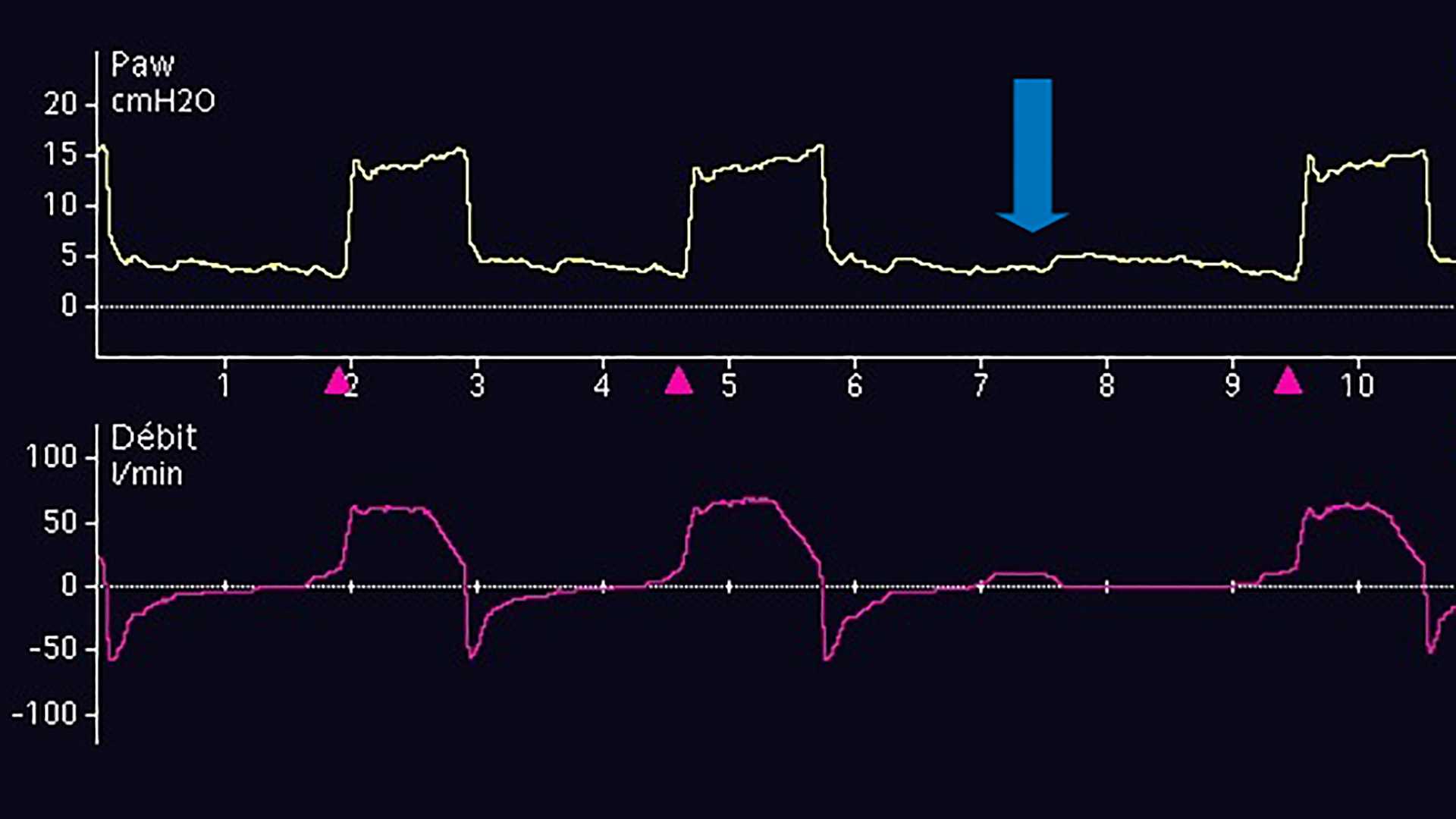 Pressure waveform with blue arrow to small decrease in baseline pressurehould start