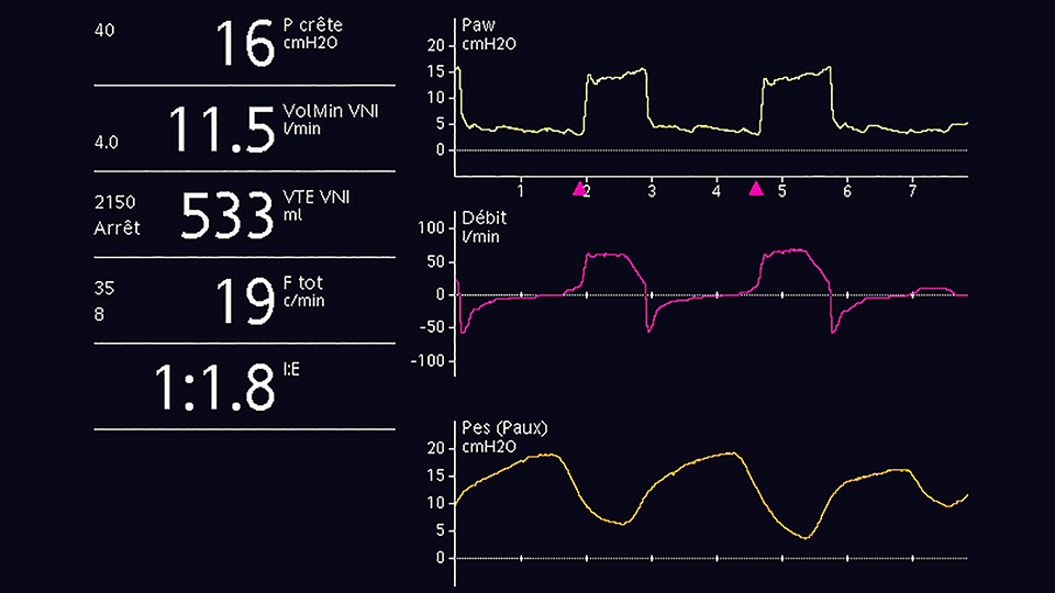 Screenshot showing pressure, flow and esophageal pressure waveforms