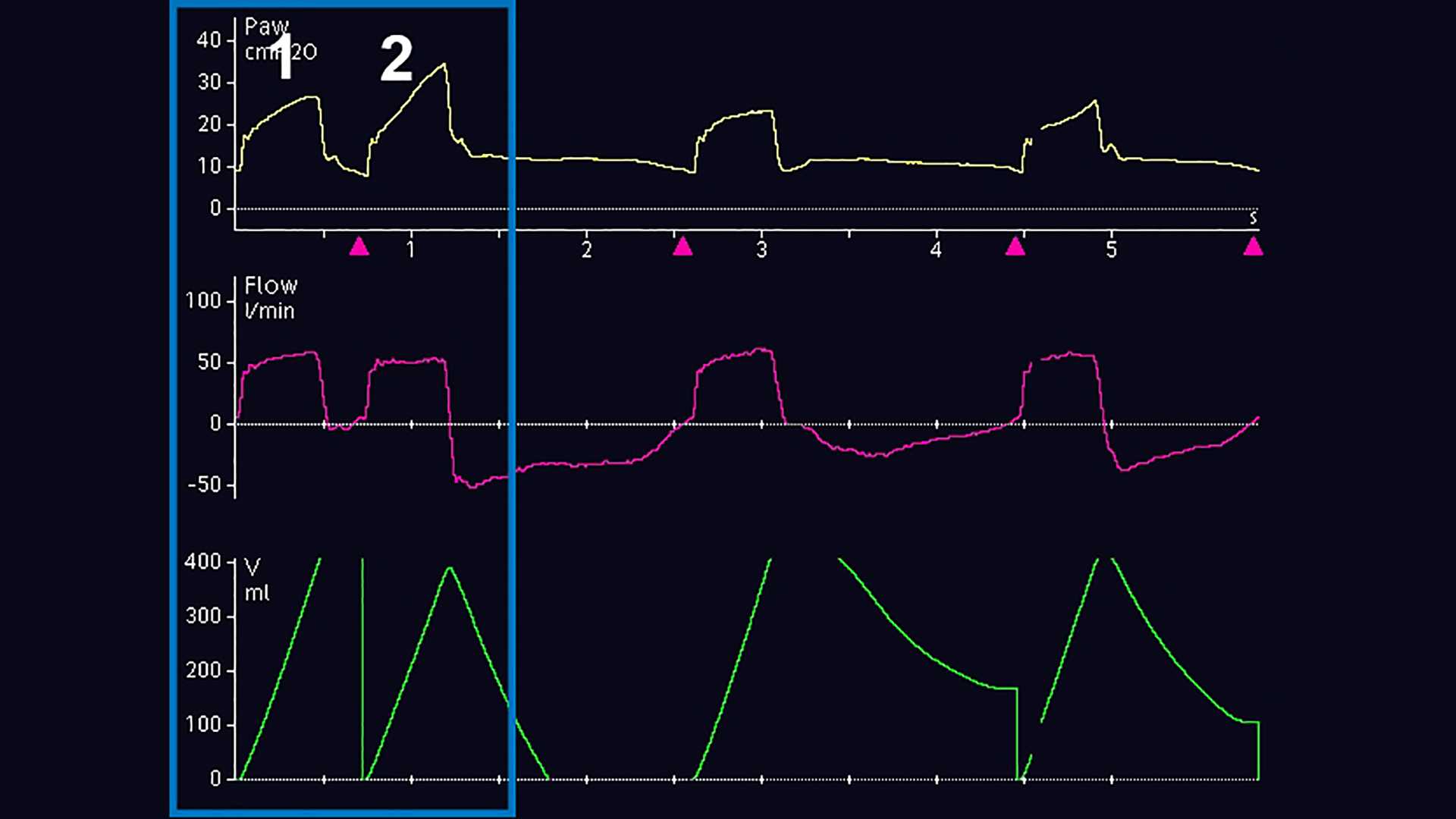 Formes d'ondes de pression, de débit et de volume affichant un déclenchement double