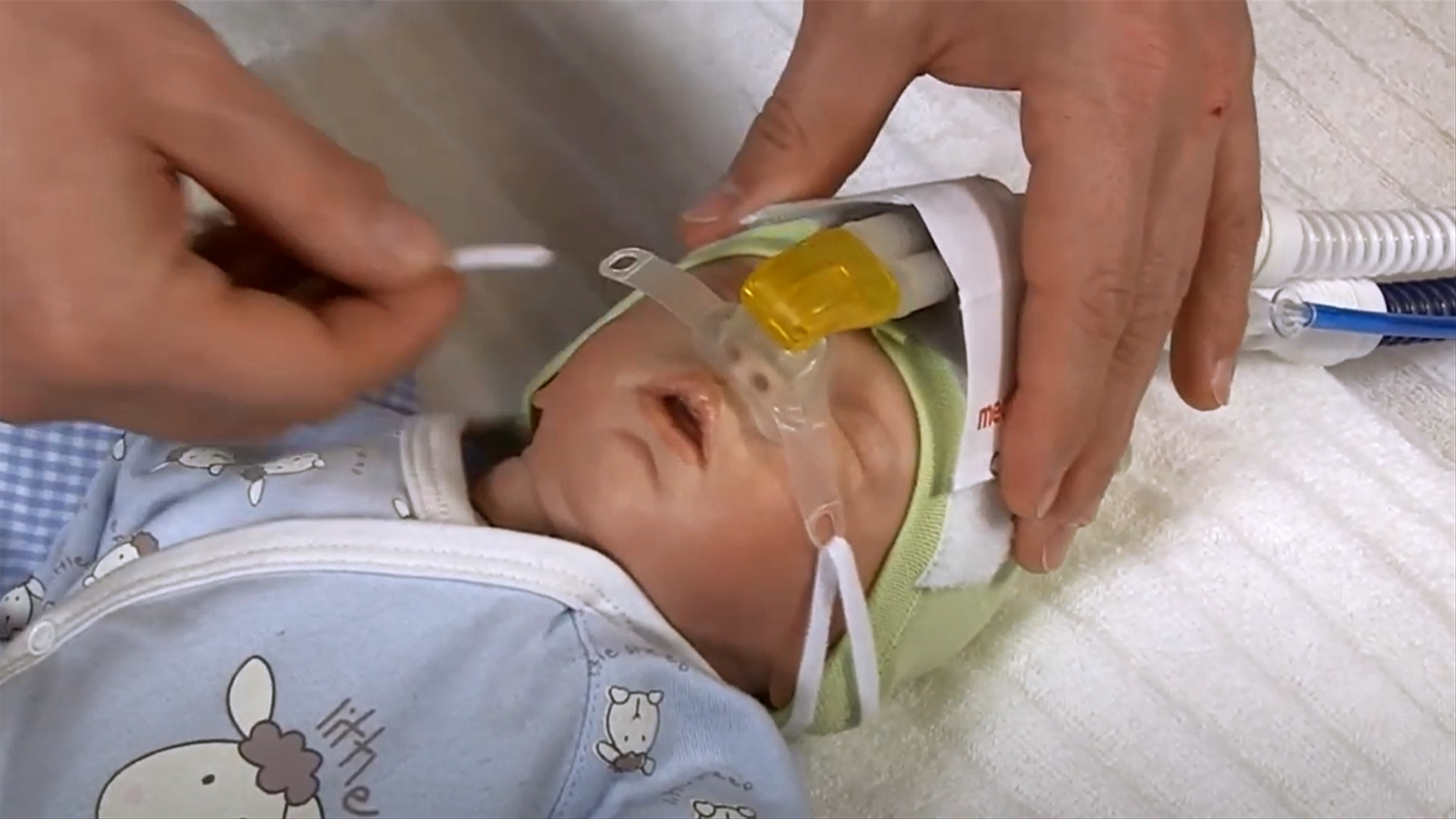 In this video we shortly demonstrate how to correctly use the medin Miniflow generator. Miniflow is a patient interface for the CPAP mode of ventilators. Therefore Miniflow can be connected to the inspiration and expiration tubes and thus to the ventilator. The ventilator adjusts and controls the CPAP parameter and provides the needed gas flow.