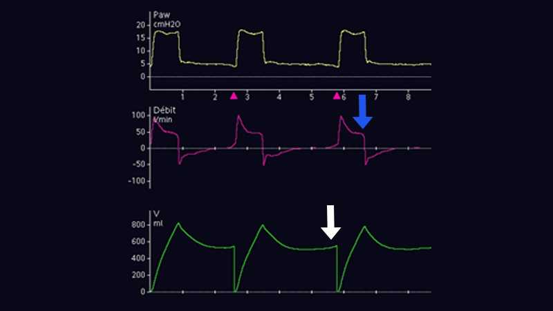 Display showing pressure, flow and volume waveforms with plateau shape on the inspiratory flow