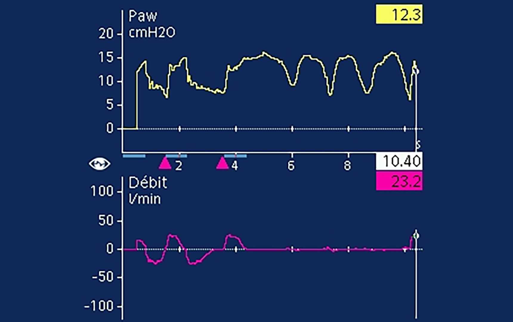 Screenshot showing non-readable plateau pressure