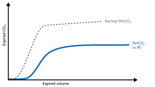 Illustration of PetCO2 in pulmonary embolism (PE) on a volumetric capnogram