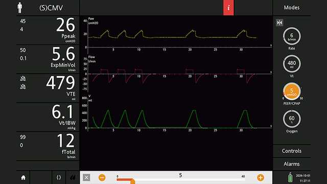 Screenshot showing PEEP decreased to 5 cmH2O