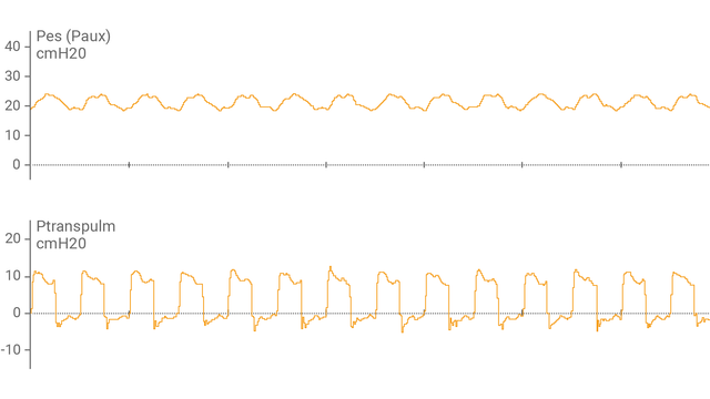 La pantalla del respirador muestra la presión esofágica (Pes) y la presión transpulmonar (Ptranspulm) en forma de onda.