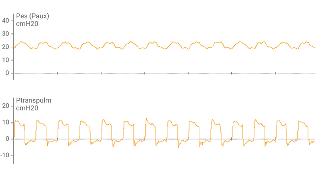 Der Bildschirm des Beatmungsgerätes zeigt den Ösophagusdruck (Pes) und die transpulmonalen Druckwerte (Ptranspulm) als Kurven an.