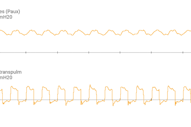 呼吸机显示屏显示食道压 (Pes) 及跨肺压 (Ptranspulm) 波形。