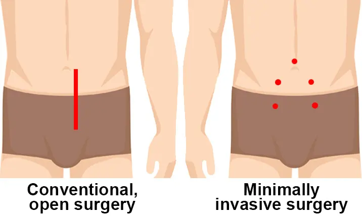 Prostatektomi invasif minimal - Manfaat