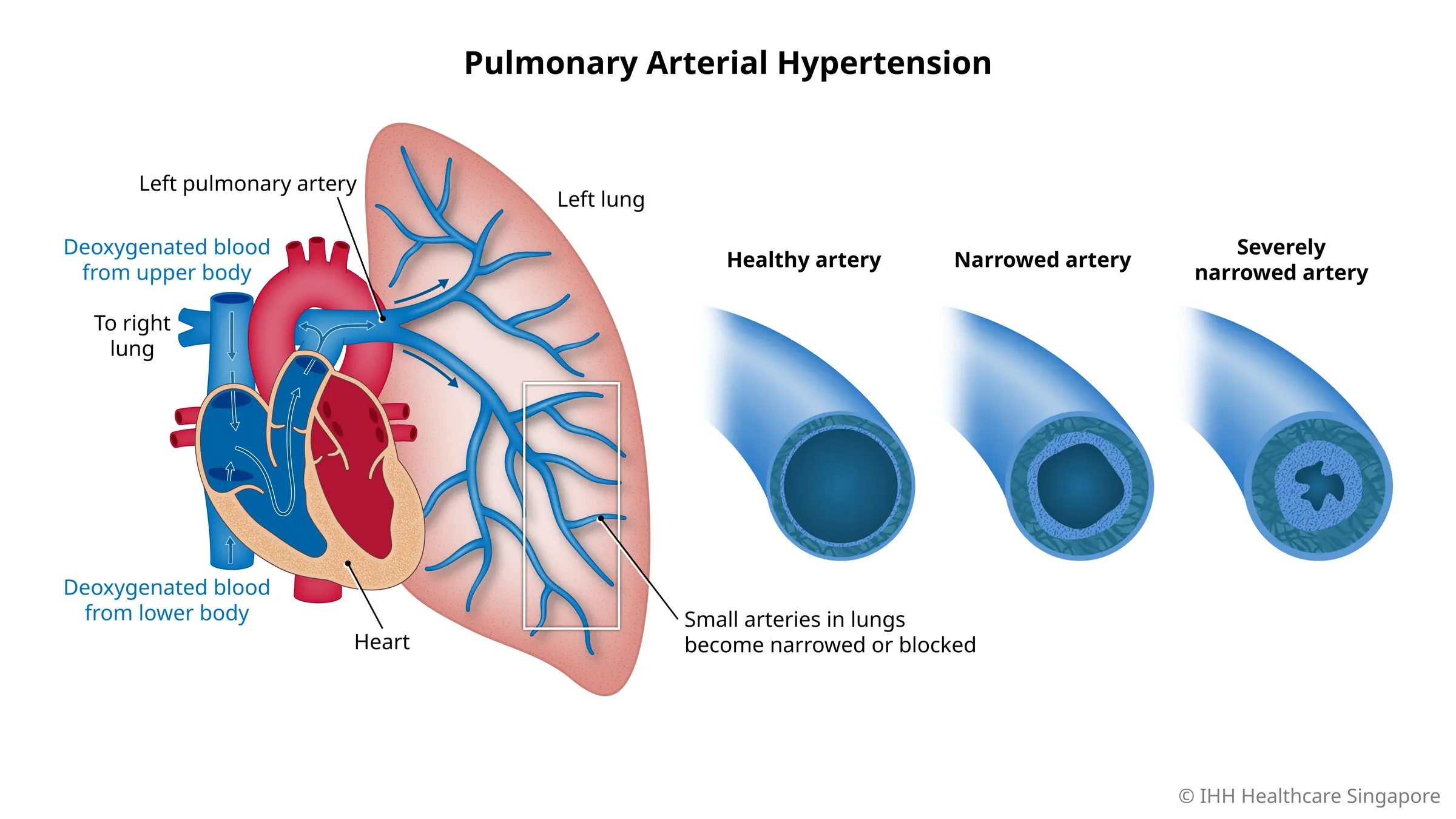 Pulmonary arterial hypertension is a form of high blood pressure where small arteries in the lungs become narrow or blocked.