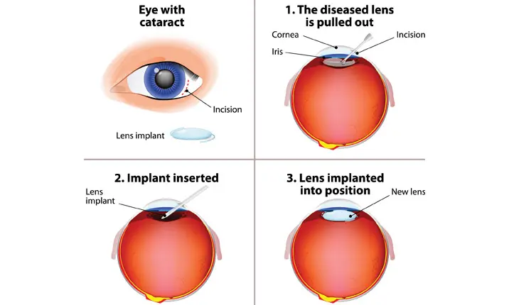 Cataract treatment