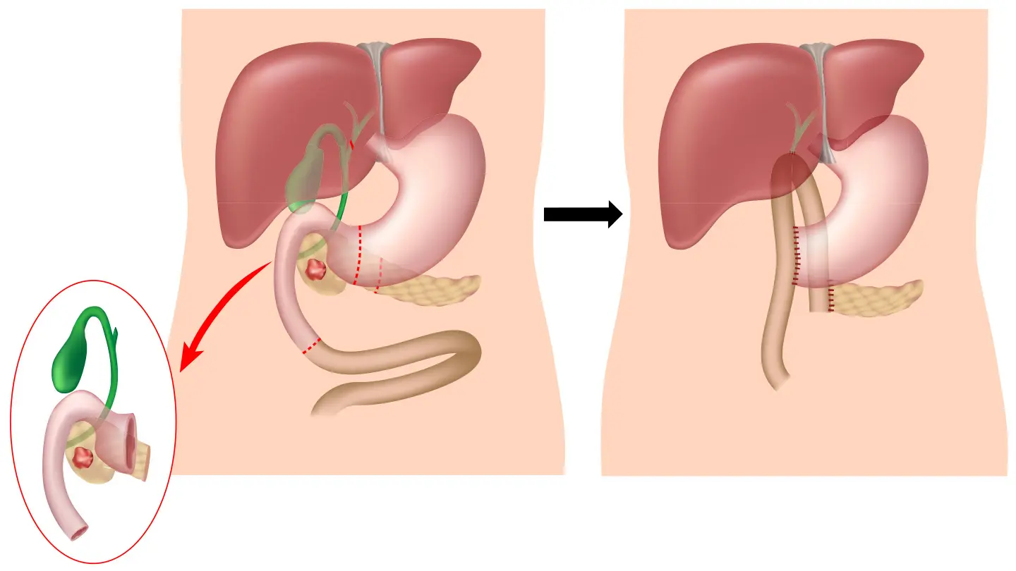 Whipple procedure