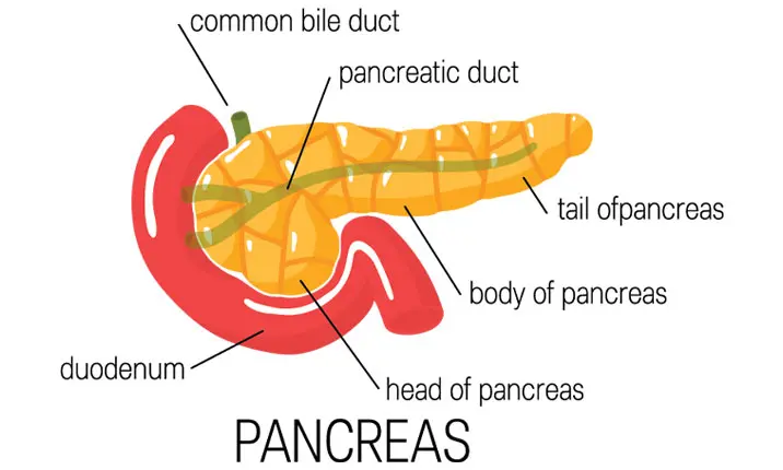 Pancreatic cancer distal subtital pancretectomy
