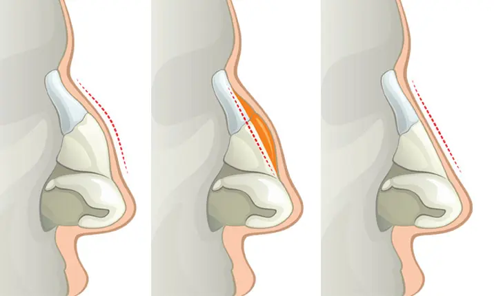 How to put hot sale in a nose bone