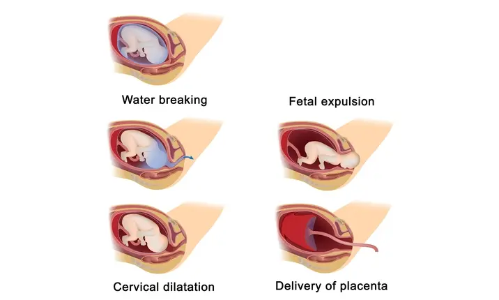 Vaginal delivery