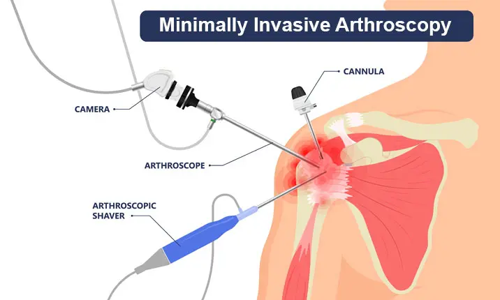 Incomplete rotator cuff repair using the hybrid technique. (a)