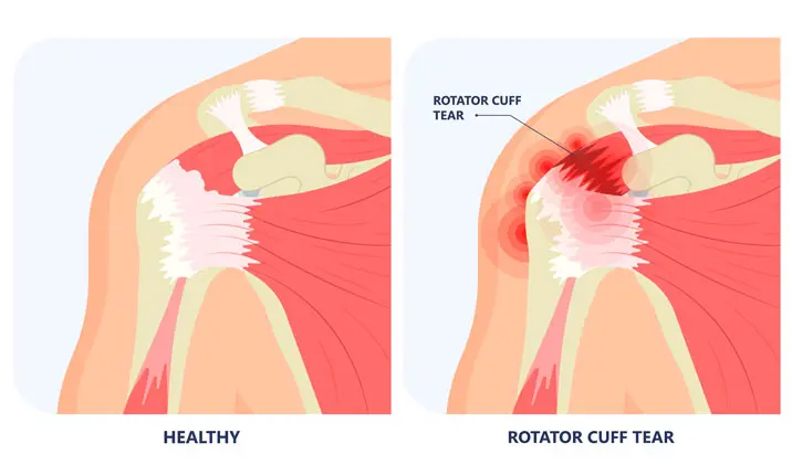 Rotator cuff tear - Specialist surgical treatment with key hole