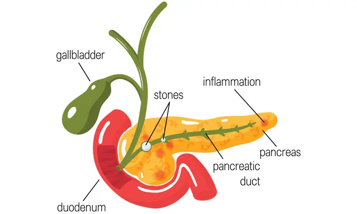 What is pancreatitis?
