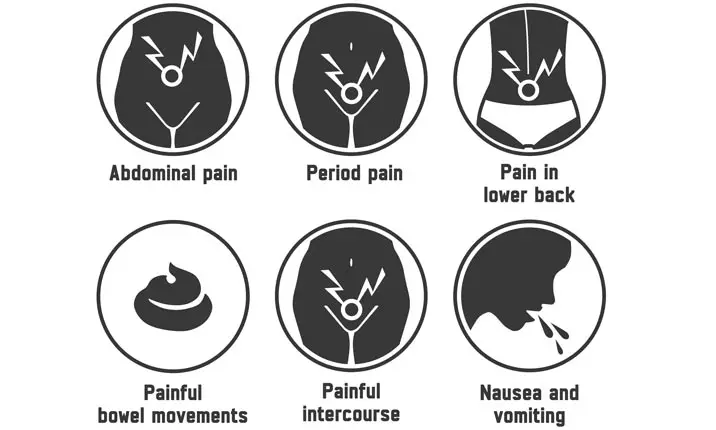 Ruptured Ovarian Cysts: Symptoms, Causes, Treatment