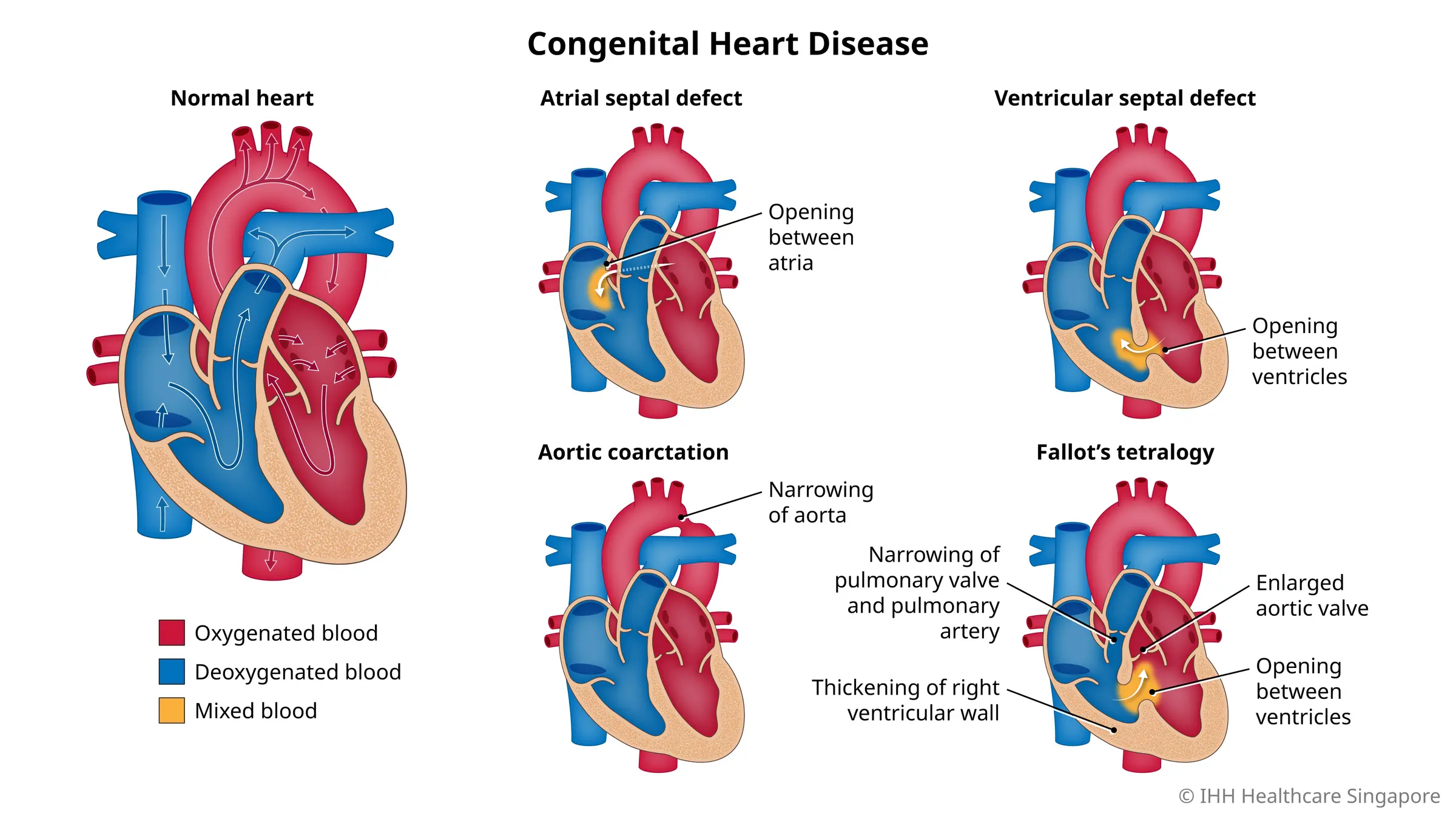 先天性心脏病包括一系列自出生起就存在的心脏缺陷，严重程度各不相同。