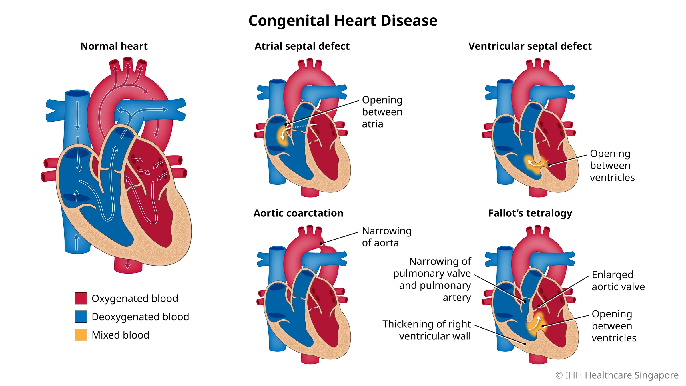 chronic-heart-disease-symptoms-causes-mount-elizabeth-hospitals