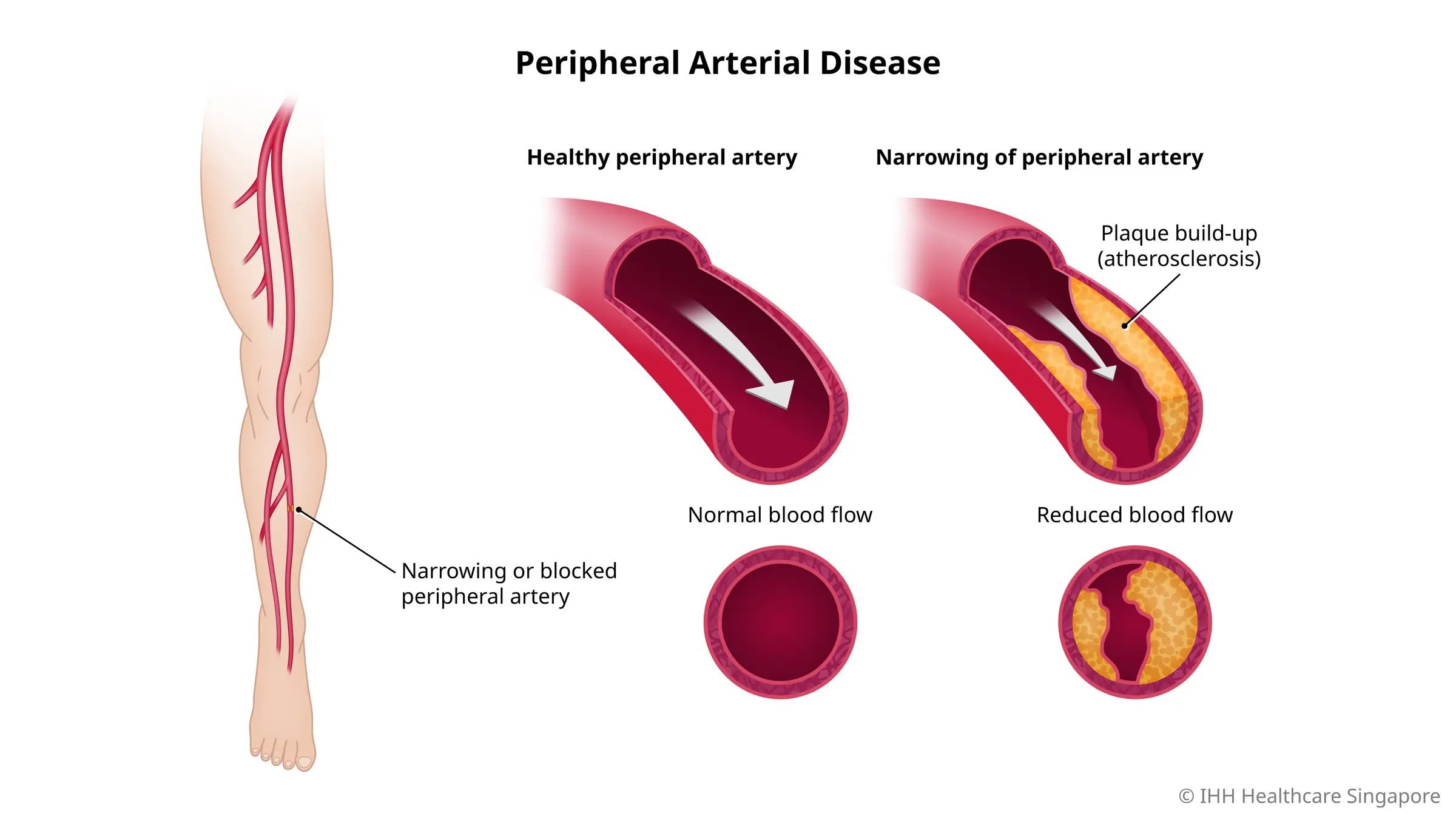 Peripheral arterial disease is usually caused by artherosclerosis and leads to reduced blood circulation to the legs.