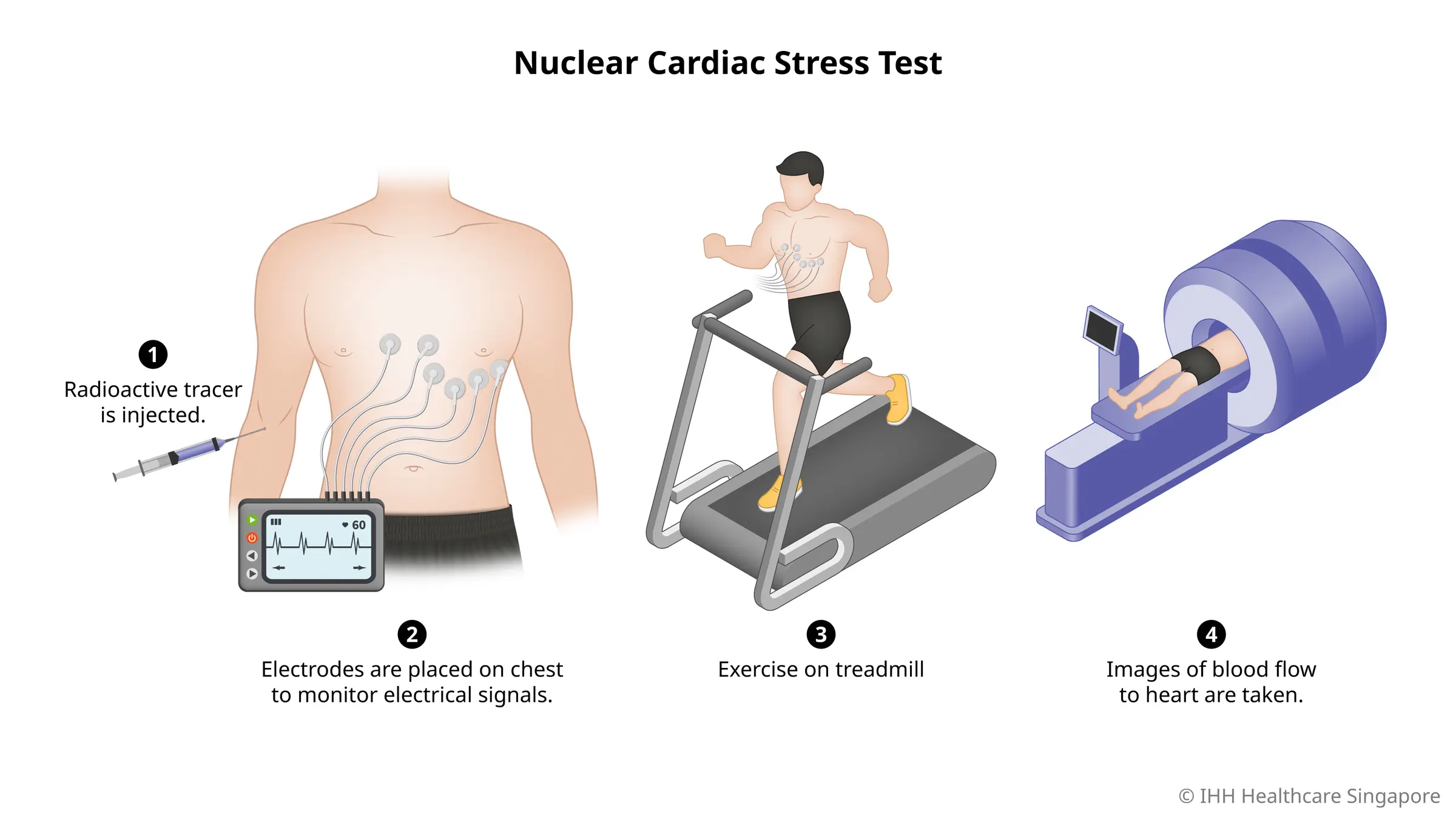 Tes stres nuklir menggunakan pelacak radioaktif untuk memeriksa aliran darah ke otot jantung selama olahraga dan istirahat.