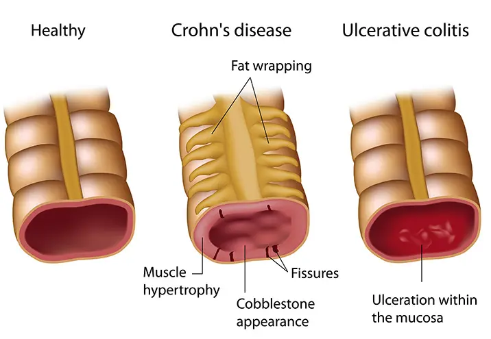 Crohn's disease and ulcerative colitis - digestive problems