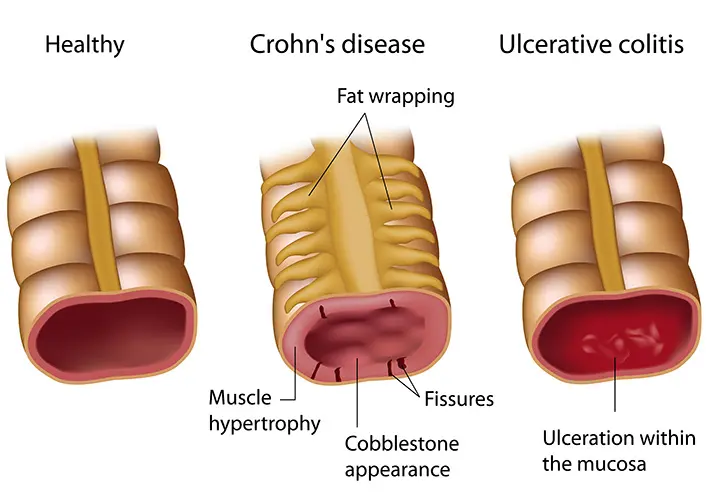 Crohn's and Ulcerative Colitis