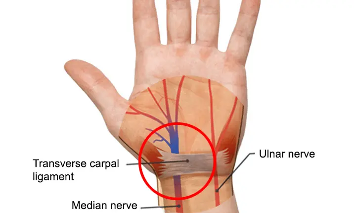 Carpal tunnel syndrome - What is it