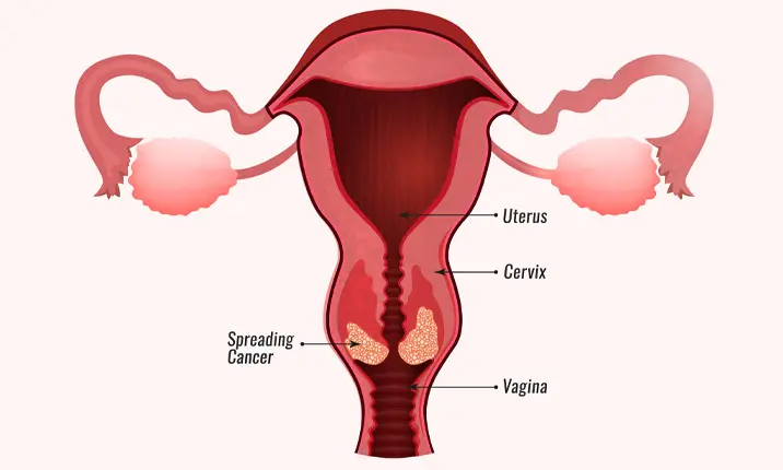 Cervical cancer and HPV