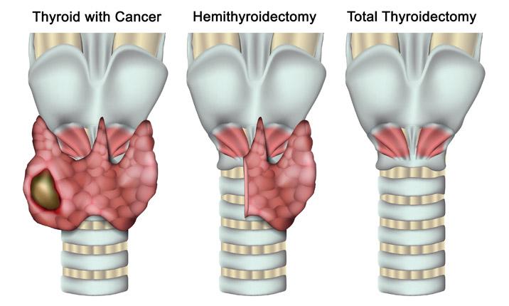 Nodul Tiroid