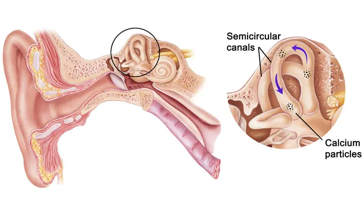 The Different Types of Vertigo & Their Common Causes