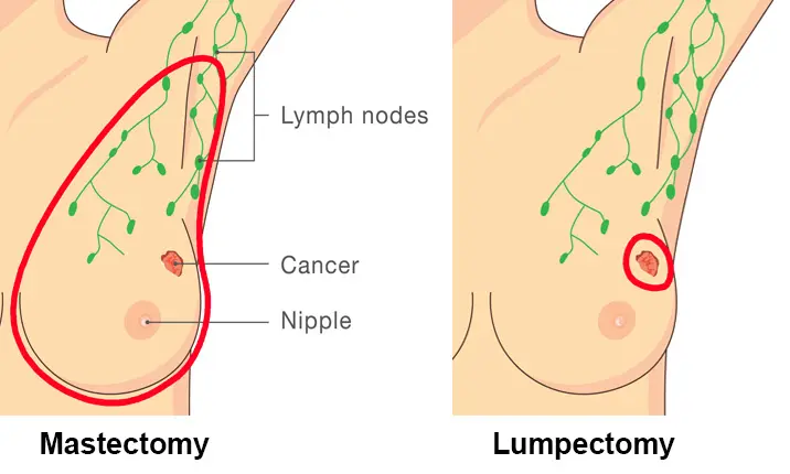 Breast cancer treatment - Oncoplastic lumpectomy