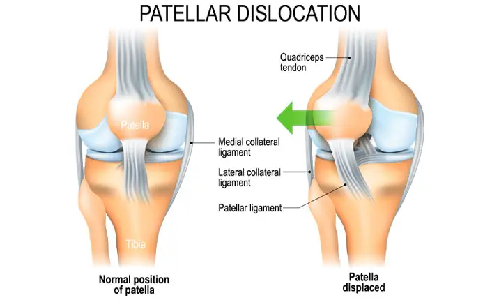 Partial knee on sale dislocation symptoms