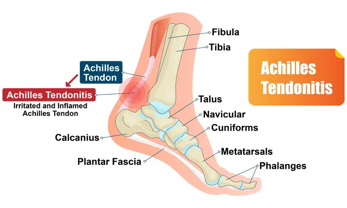 Achilles tendonitis