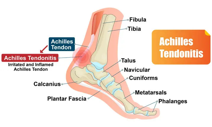 Sudden heel shop pain