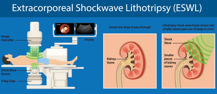 Extracorporeal shock wave lithotripsy
