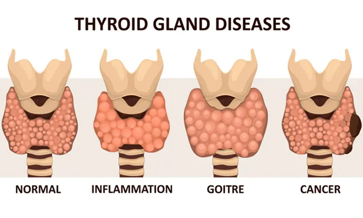 Pembedahan kepala, leher, dan tiroid - Gangguan tiroid