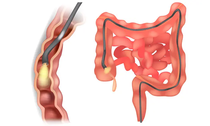 lower endoscopy procedure